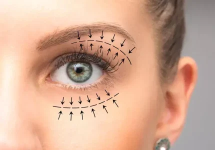 بلفاروپلاستی